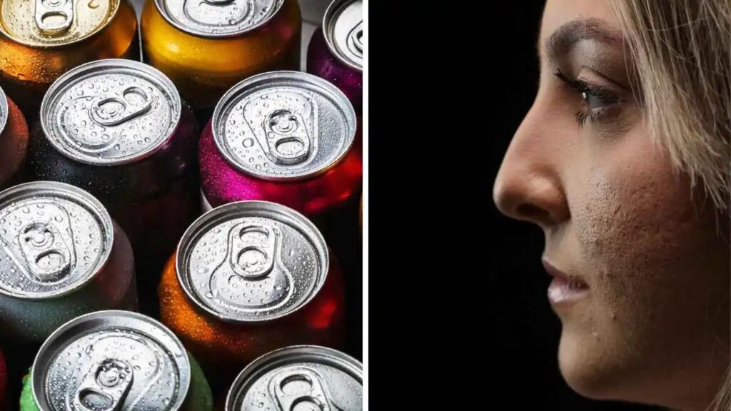 A composite image showing a collection of colorful beverage cans (energy drinks or soda) next to a side profile of a person's face with rough or acne-prone skin, illustrating the potential link between sugary drinks and skin issues.
