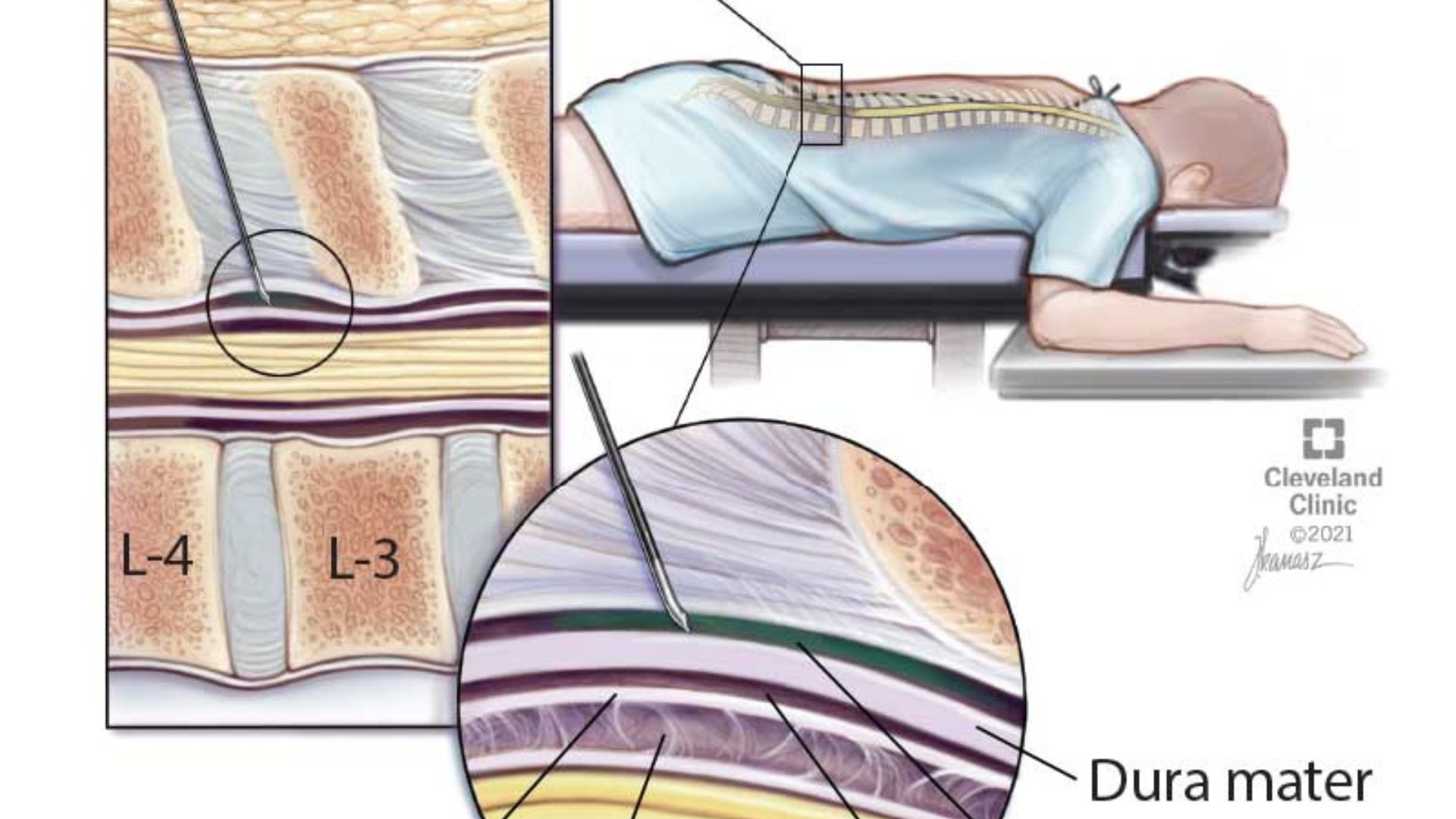 Can I Drink Alcohol Before Epidural Steroid Injection