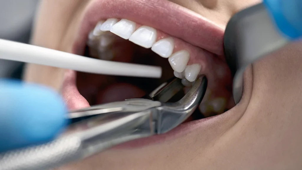 When Can You Drink from a Straw After Wisdom Teeth.”