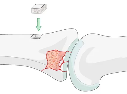 Illustration of a bone graft being placed into a damaged bone area, showing the healing site where new bone regeneration occurs, related to how alcohol can interfere with osseointegration and recovery.