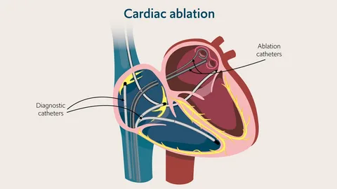 Diagram of the cardiac ablation procedure showing catheters inside the heart, used to explain how ablation treats arrhythmias and why proper recovery and aftercare are important.