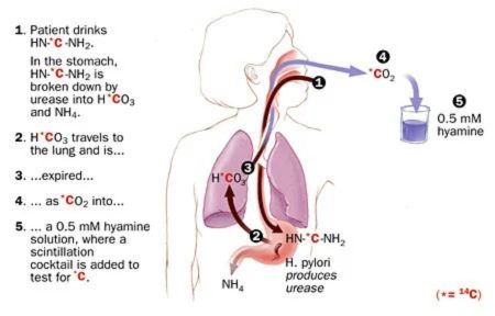 Medical diagram showing how the H. pylori breath test works, including urea breakdown and CO2 release, explaining the importance of avoiding too much water before the test for accurate results.